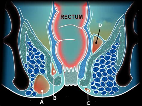 perineal raphe irritation  Area: perineum I've been having pain and inflammation in my perineal area, more accurately at the ridge